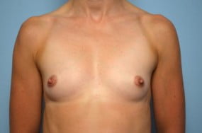 Breast Surgery Breast Augmentation