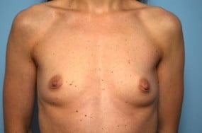 Breast Surgery Breast Augmentation