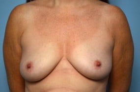 Breast Surgery Breast Lift with Augmentation