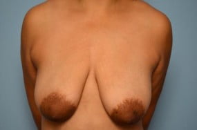 Breast Surgery Breast Lift