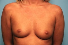 Breast Surgery Breast Augmentation