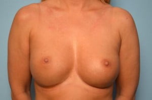 Breast Surgery Breast Augmentation