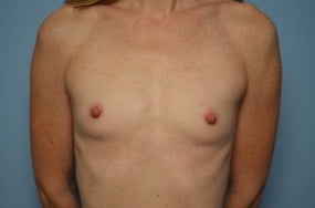 Breast Surgery Breast Augmentation