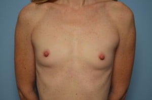 Breast Surgery Breast Augmentation