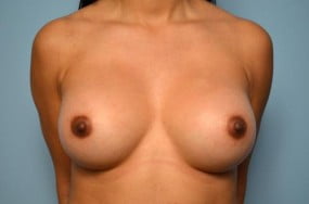 Breast Surgery Breast Augmentation