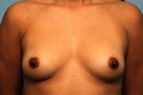 Breast Surgery Breast Augmentation