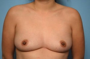 Breast Surgery Breast Augmentation