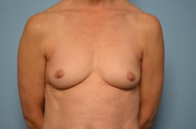 Breast Surgery Breast Augmentation