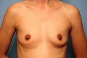Breast Surgery Breast Augmentation