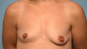 Breast Surgery Breast Augmentation