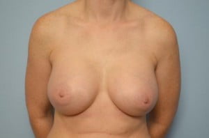 Breast Surgery Breast Augmentation