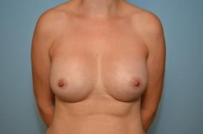 Breast Surgery Breast Augmentation