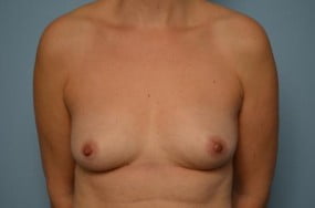 Breast Surgery Breast Augmentation