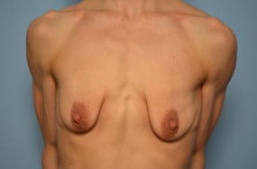 Breast Surgery Breast Lift with Augmentation