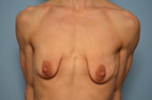 Breast Surgery Breast Lift with Augmentation