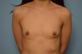 Breast Surgery Breast Augmentation