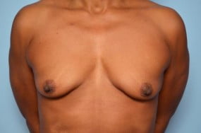 Breast Surgery Breast Lift with Augmentation