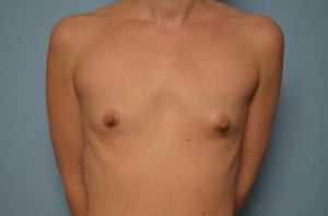 Breast Surgery Breast Augmentation