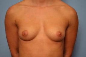 Breast Surgery Breast Augmentation