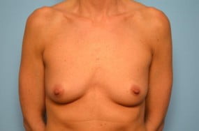 Breast Surgery Breast Augmentation