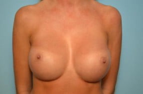 Breast Surgery Breast Augmentation