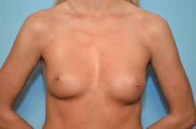 Breast Surgery Breast Augmentation