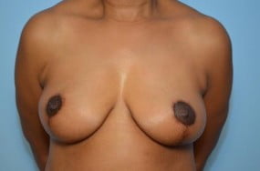 Breast Surgery Breast Lift