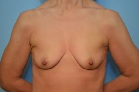 Breast Surgery Breast Augmentation