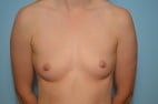 Breast Surgery Breast Augmentation