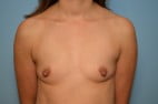 Breast Surgery Breast Augmentation