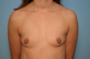 Breast Surgery Breast Augmentation