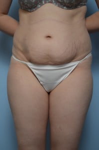 Body Contouring Tummy Tuck