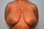 Breast Surgery Breast Reduction