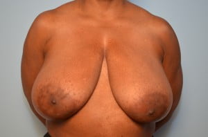 Breast Surgery Breast Reduction