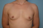 Breast Surgery Breast Augmentation