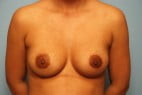 Breast Surgery Breast Implant Revision