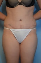 Body Contouring Tummy Tuck