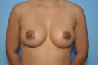 Breast Surgery Breast Implant Revision