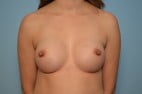 Breast Surgery Breast Augmentation