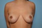 Breast Surgery Breast Lift