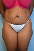 Body Contouring Abdominoplasty