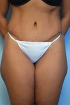 Body Contouring Abdominoplasty