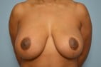 Breast Implant Removal