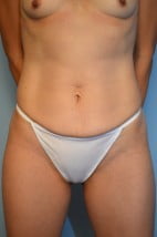 Umbilical Float Tummy Tuck