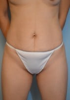 Umbilical Float Tummy Tuck