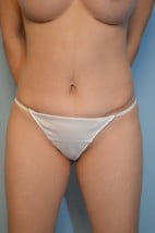 Umbilical Float Tummy Tuck