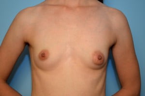 Correction of Tubular Breast