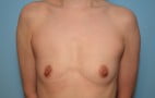 Breast Augmentation