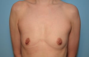 Breast Augmentation