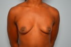 Breast Augmentation